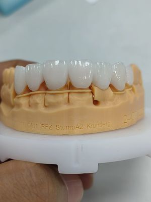 5mm-6mm στρωμένα στέμματα από ζιρκόνια Δύναμη πολυστρωτού στέμματος από ζιρκόνια