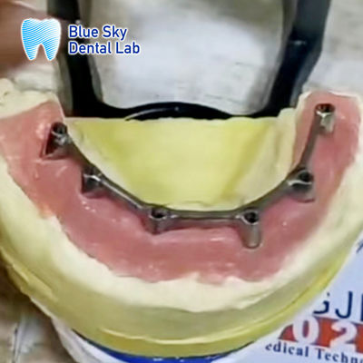 Τιτανίου Bar Overdenture αφαιρούμενο εμφύτευμα με Overdenture
